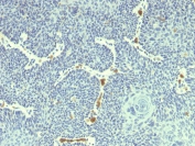 IHC staining of FFPE human cervix with HPV18 E6 antibody (clone HPV18/1297). HIER: boil tissue sections in pH 9 10mM Tris with 1mM EDTA for 20 min and allow to cool before testing.