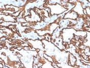 IHC staining of FFPE human angiosarcoma with CD31 antibody (clone PECAM1/3529). HIER: boil tissue sections in pH 9 10mM Tris with 1mM EDTA for 10-20 min and allow to cool before testing.