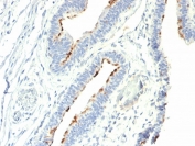 IHC staining of FFPE human colon carcinoma with Thomsen-Friedenreich Antigen antibody (clone A78-G/A7). HIER: boil tissue sections in pH 9 10mM Tris with 1mM EDTA for 20 min and allow to cool before testing.