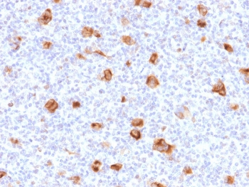 IHC staining of FFPE human Hodgkin's lymphoma with Bcl-X antibody (clone SPM519). HIER: boil tissue sections in pH 9 10mM Tris with 1mM EDTA for 20 min and allow to cool before testing.~