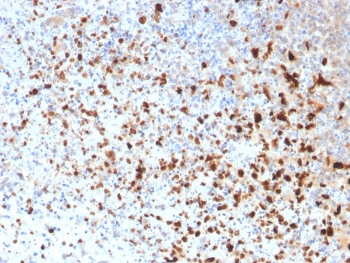 IHC staining of FFPE human cervix with HSV1 antibody (clone 10A3). Required HIER: boil tissue sections in pH 9 10mM Tris with 1mM EDTA for 10-20 min followed by cooling at RT for 20 min.~