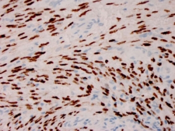 IHC staining of FFPE Kaposi’s sarcoma with Herpes Virus 8 antibody (clone HHV8/3606). HIER: boil tissue sections in pH 9 10mM Tris with 1mM EDTA for 20 min and allow to cool before testing.~