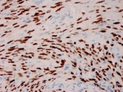 IHC staining of FFPE Kaposiâs sarcoma with Herpes Virus 8 antibody (clone HHV8/3606). HIER: boil tissue sections in pH 9 10mM Tris with 1mM EDTA for 20 min and allow to cool before testing.