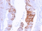IHC staining of FFPE human colon carcinoma with recombinant CK20 antibody (clone KRT20/3129R). HIER: boil tissue sections in pH 9 10mM Tris with 1mM EDTA for 20 min and allow to cool before testing.