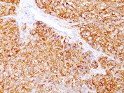 IHC staining of FFPE human melanoma tissue with Melanoma Marker antibody cocktail (clones DT101+ BC199 + HMB45). HIER: boil tissue sections in pH 9 10mM Tris with 1mM EDTA for 20 min and allow to cool before testing.