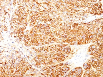 IHC staining of FFPE human melanoma tissue with Melanoma Marker antibody cocktail (clones DT101+ BC199 + HMB45). HIER: boil tissue sections in pH 9 10mM Tris with 1mM EDTA for 20 min and allow to cool before testing.~