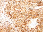 IHC staining of FFPE human melanoma tissue with Melanoma Marker antibody cocktail (clones DT101+ BC199 + HMB45). HIER: boil tissue sections in pH 9 10mM Tris with 1mM EDTA for 20 min and allow to cool before testing.
