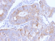 IHC staining of FFPE human colon carcinoma with Thomsen-Friedenreich Antigen antibody (clone A63-C/A9). HIER: boil tissue sections in pH 9 10mM Tris with 1mM EDTA for 20 min and allow to cool before testing.