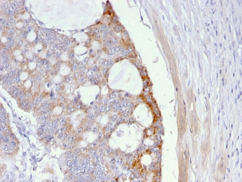 IHC staining of FFPE human colon carcinoma with Thomsen-Friedenreich Antigen antibody (clone A63-C/A9). HIER: boil tissue sections in pH 9 10mM Tris with 1mM EDTA for 20 min and allow to cool before testing.~