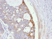 IHC staining of FFPE human colon carcinoma with Thomsen-Friedenreich Antigen antibody (clone A63-C/A9). HIER: boil tissue sections in pH 9 10mM Tris with 1mM EDTA for 20 min and allow to cool before testing.