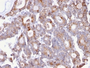 IHC staining of FFPE human colon carcinoma with Thomsen-Friedenreich Antigen antibody (clone A84-A/F10). HIER: boil tissue sections in pH 9 10mM Tris with 1mM EDTA for 20 min and allow to cool before testing.