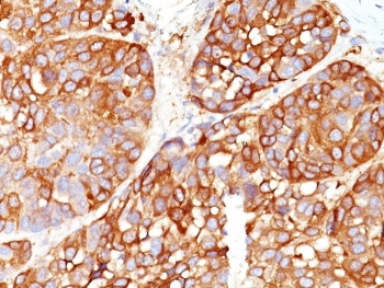 IHC staining of FFPE human melanoma tissue with Melanoma Marker antibody cocktail (clones DT101+ BC199 + T311 + HMB45). HIER: boil tissue sections in pH 9 10mM Tris with 1mM EDTA for 20 min and allow to cool before testing.