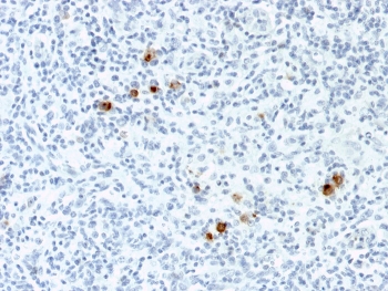 IHC staining of FFPE Hodgkin's Lymphoma with EBV antibody (clone CS4). HIER: boil tissue sections in pH 9 10mM Tris with 1mM EDTA for 10-20 min and allow to cool before testing.~