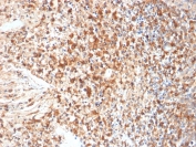 IHC staining of FFPE human cervix with HSV1 antibody (clone HSVI/2095). Required HIER: boil tissue sections in pH 9 10mM Tris with 1mM EDTA for 10-20 min followed by cooling at RT for 20 min.