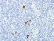 IHC staining of FFPE Hodgkin's Lymphoma with EBV antibody cocktail (clone CS1-4). HIER: boil tissue sections in pH 9 10mM Tris with 1mM EDTA for 10-20 min and allow to cool before testing.