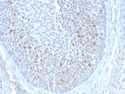 IHC staining of FFPE human cervix with HPV16 E1/E4 antibody. HIER: boil tissue sections in pH 9 10mM Tris with 1mM EDTA for 20 min and allow to cool before testing.