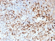 IHC staining of FFPE human cervix with HSV1 antibody. Required HIER: boil tissue sections in pH 9 10mM Tris with 1mM EDTA for 10-20 min followed by cooling at RT for 20 min.