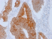 IHC staining of FFPE human colon with Aurora B antibody (clone AURKB/1592). HIER: boil tissue sections in pH 9 10mM Tris with 1mM EDTA for 20 min and allow to cool before testing.