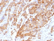 IHC staining of FFPE human prostate carcinoma with Aurora B antibody (clone AURKB/1592). HIER: boil tissue sections in pH 9 10mM Tris with 1mM EDTA for 20 min and allow to cool before testing.