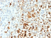 IHC staining of FFPE human melanoma with recombinant Vimentin antibody (clone VIM/1937R). HIER: boil tissue sections in pH 9 10mM Tris with 1mM EDTA for 20 min and allow to cool before testing.