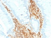 IHC staining of FFPE human colon carcinoma with recombinant Vimentin antibody (clone VIM/1937R). HIER: boil tissue sections in pH 9 10mM Tris with 1mM EDTA for 20 min and allow to cool before testing.