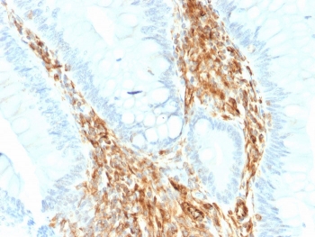 IHC staining of FFPE human colon carcinoma with recombinant Vimentin antibody (clone VIM/1937R). HIER: boil tissue sections in pH 9 10mM Tris with 1mM EDTA for 20 min and allow to cool before testing.
