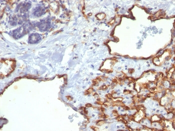 IHC staining of FFPE human angiosarcoma with CD31 antibody (clone SPM122). HIER: boil tissue sections in pH 9 10mM Tris with 1mM EDTA for 10-20 min and allow to cool before testing.~