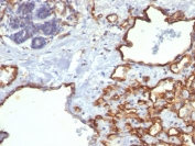 IHC staining of FFPE human angiosarcoma with CD31 antibody (clone SPM122). HIER: boil tissue sections in pH 9 10mM Tris with 1mM EDTA for 10-20 min and allow to cool before testing.