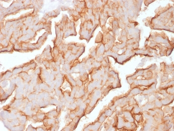 IHC staining of FFPE human ovarian carcinoma with recombinant MUC16 antibody (clone OCA125/1900). HIER: boil tissue sections in pH 9 10mM Tris with 1mM EDTA for 20 min and allow to cool before testing.~