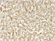 IHC staining of FFPE human liver carcinoma with FABP1 antibody (clone FABP1/3482). HIER: boil tissue sections in pH 9 10mM Tris with 1mM EDTA for 20 min and allow to cool before testing.