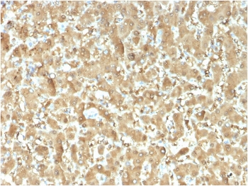 IHC staining of FFPE human liver carcinoma with FABP1 antibody (clone FABP1/3482). HIER: boil tissue sections in pH 9 10mM Tris with 1mM EDTA for 20 min and allow to cool before testing.