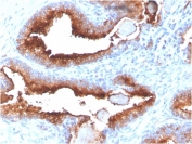 IHC staining of FFPE human prostate carcinoma with FOLH1 antibody (clone FOLH1/3734). HIER: boil tissue sections in pH 9 10mM Tris with 1mM EDTA for 20 min and allow to cool before testing.