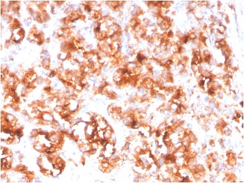 IHC staining of FFPE human prostate carcinoma with FOLH1 antibody. HIER: boil tissue sections in pH 9 10mM Tris with 1mM EDTA for 20 min and allow to cool before testing.