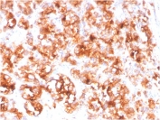 IHC staining of FFPE human prostate carcinoma with FOLH1 antibody (clone FOLH1/3734). HIER: boil tissue sections in pH 9 10mM Tris with 1mM EDTA for 20 min and allow to cool before testing.