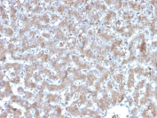 IHC staining of FFPE human hepatocellular carcinoma with A20 antibody (clone TNFAIP3/2813). HIER: boil tissue sections in pH 9 10mM Tris with 1mM EDTA for 20 min and allow to cool before testing.