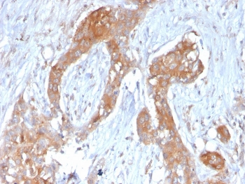 IHC staining of FFPE human breast carcinoma with A20 antibody (clone TNFAIP3/2813). HIER: boil tissue sections in pH 9 10mM Tris with 1mM EDTA for 20 min and allow to cool before testing.~