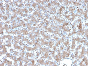 IHC staining of FFPE human hepatocellular carcin