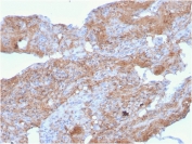 IHC staining of FFPE human lung with FN1 antibody (clone FN1/2948). HIER: boil tissue sections in pH 9 10mM Tris with 1mM EDTA for 20 min and allow to cool before testing.