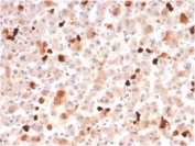 IHC staining of FFPE human liver with APOA1 antibody. HIER: boil tissue sections in pH 9 10mM Tris with 1mM EDTA for 20 min and allow to cool before testing.