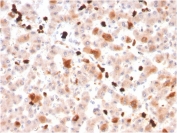 IHC staining of FFPE human liver with APOA1 antibody. HIER: boil tissue sections in pH 9 10mM Tris with 1mM EDTA for 20 min and allow to cool before testing.
