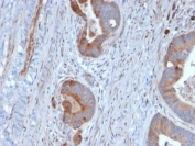 IHC staining of FFPE human prostate with Cytokeratin 6B antibody (clone KRT6B/2116). HIER: boil tissue sections in pH 9 10mM Tris with 1mM EDTA for 20 min and allow to cool before testing.