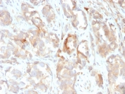 IHC staining of FFPE human prostate with Cytokeratin 6B antibody (clone KRT6B/2116). HIER: boil tissue sections in pH 9 10mM Tris with 1mM EDTA for 20 min and allow to cool before testing.