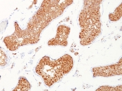 IHC staining of FFPE human testicular carcinoma with INHA antibody. HIER: boil tissue sections in pH 9 10mM Tris with 1mM EDTA for 20 min and allow to cool before testing.