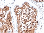IHC staining of FFPE human testicular carcinoma with INHA antibody (clone R1). HIER: boil tissue sections in pH 9 10mM Tris with 1mM EDTA for 20 min and allow to cool before testing.