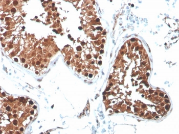 IHC staining of FFPE human testicular carcinoma with INHA antibody (clone R1). HIER: boil tissue sections in pH 9 10mM Tris with 1mM EDTA for 20 min and allow to cool before testing.~