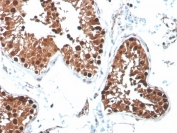 IHC staining of FFPE human testicular carcinoma with INHA antibody (clone R1). HIER: boil tissue sections in pH 9 10mM Tris with 1mM EDTA for 20 min and allow to cool before testing.