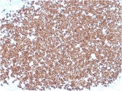 IHC staining of FFPE human thymus with TdT antibody (clone TDT/1393). HIER: boil tissue sections in pH 9 10mM Tris with 1mM EDTA for 20 min and allow to cool before testing.