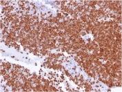 IHC staining of FFPE human thymus with TdT antibody (clone TDT/1393). HIER: boil tissue sections in pH 9 10mM Tris with 1mM EDTA for 20 min and allow to cool before testing.