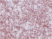 IHC staining of FFPE human thymoma with TdT antibody (clone TDT/1393). HIER: boil tissue sections in pH 9 10mM Tris with 1mM EDTA for 20 min and allow to cool before testing.