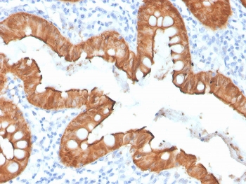 IHC staining of FFPE human colon with recombinant Villin antibody (clone VIL1/4107R). HIER: boil tissue sections in pH 9 10mM Tris with 1mM EDTA for 20 min and allow to cool before testing.~